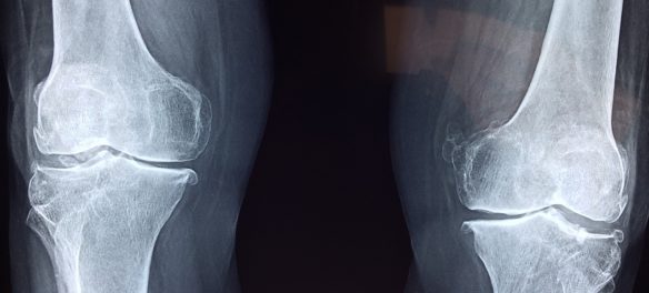 injury-knee