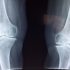 injury-knee